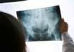 Osteoporose menopause lamenopaus