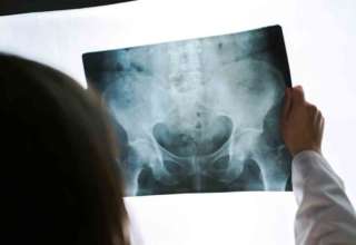 Osteoporose menopause lamenopaus