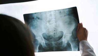 Osteoporose menopause lamenopaus